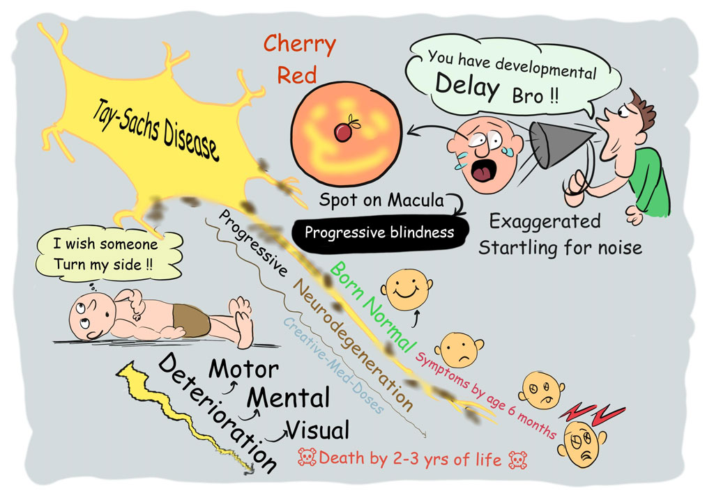 Cherry-Red Spot in Tay–Sachs Disease