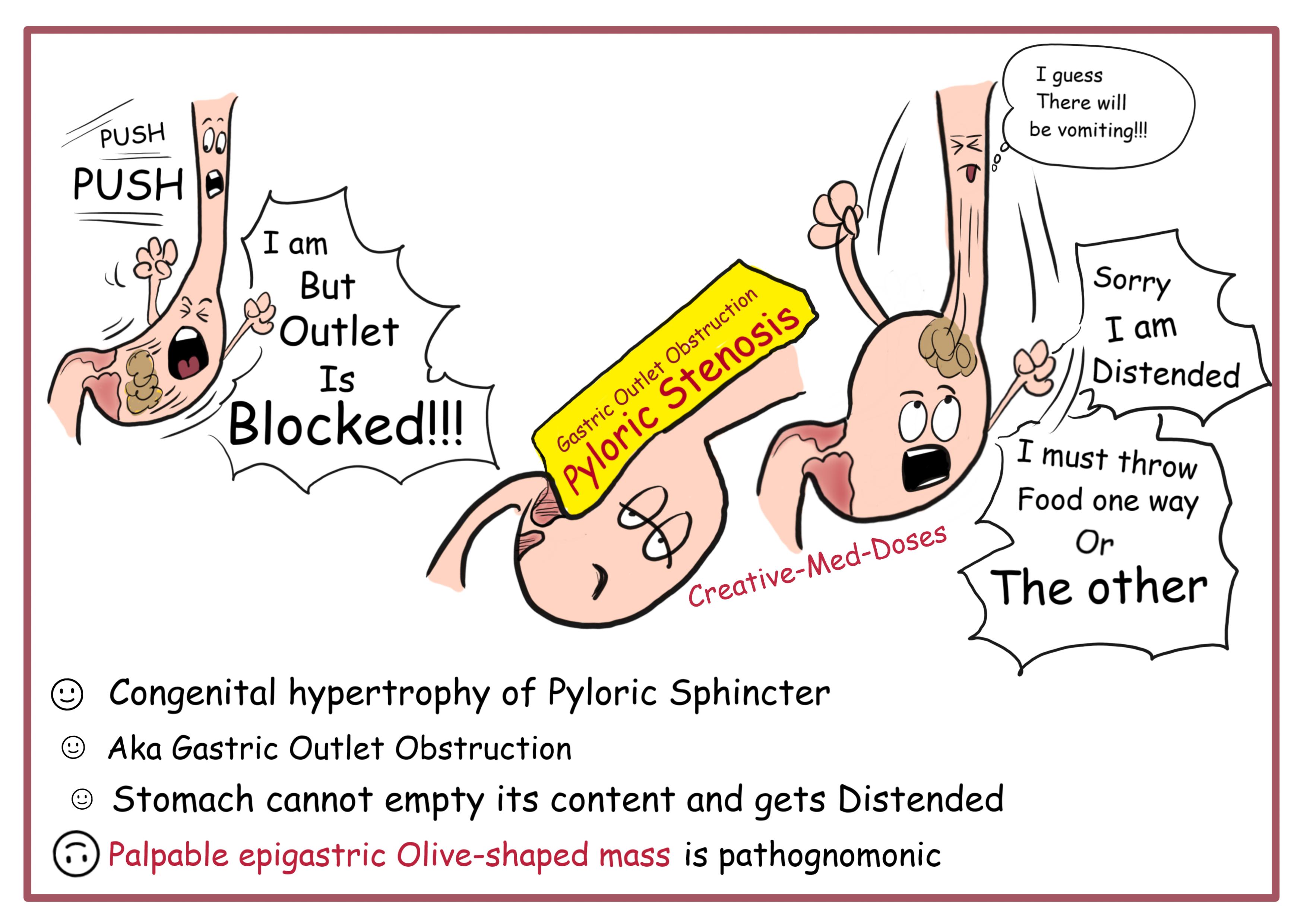 Congenital hypertrophic pyloric stenosis introductory visual map