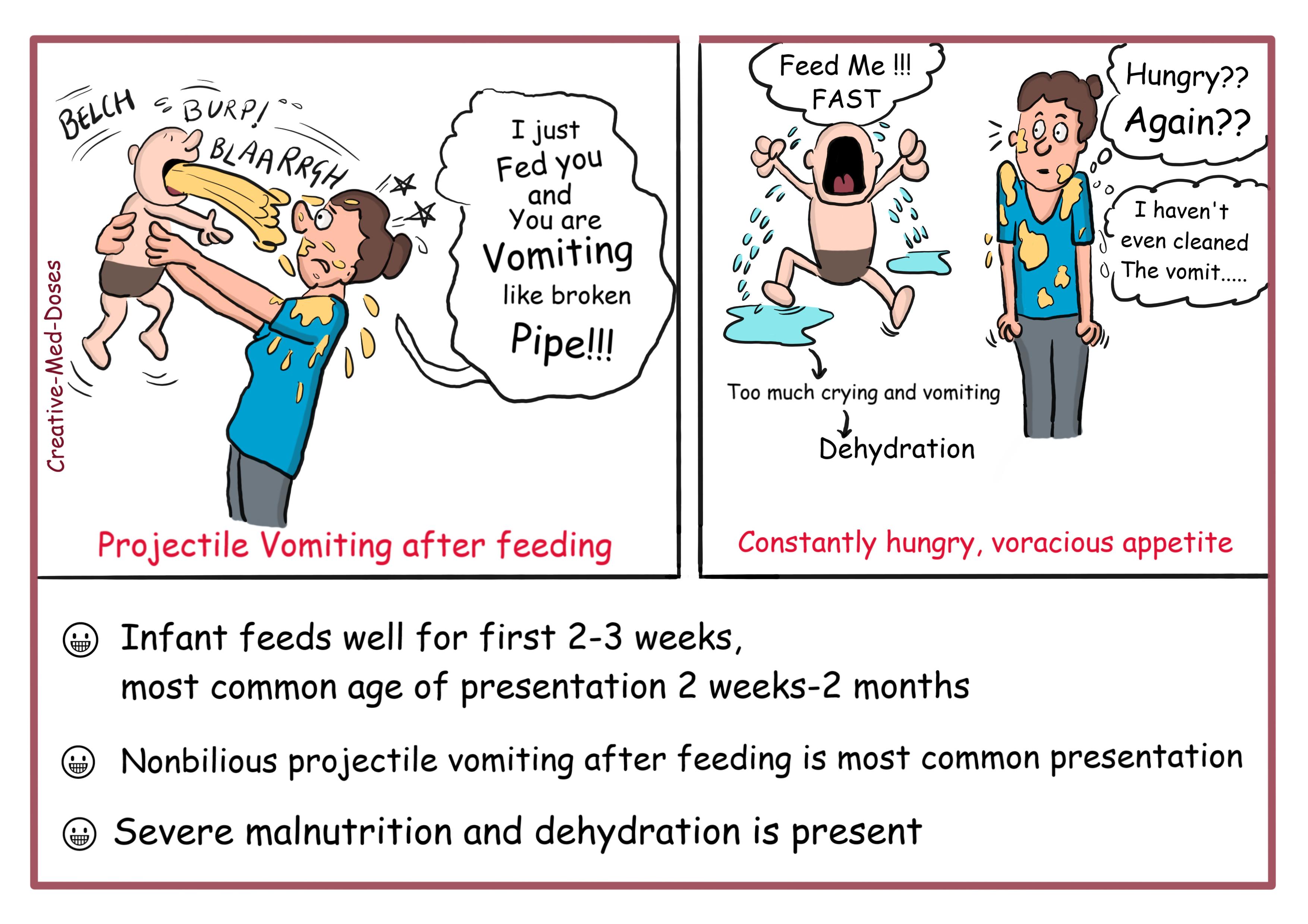 Congenital Hypertrophic pyloric stenosis (CHPS) - Creative Med Doses