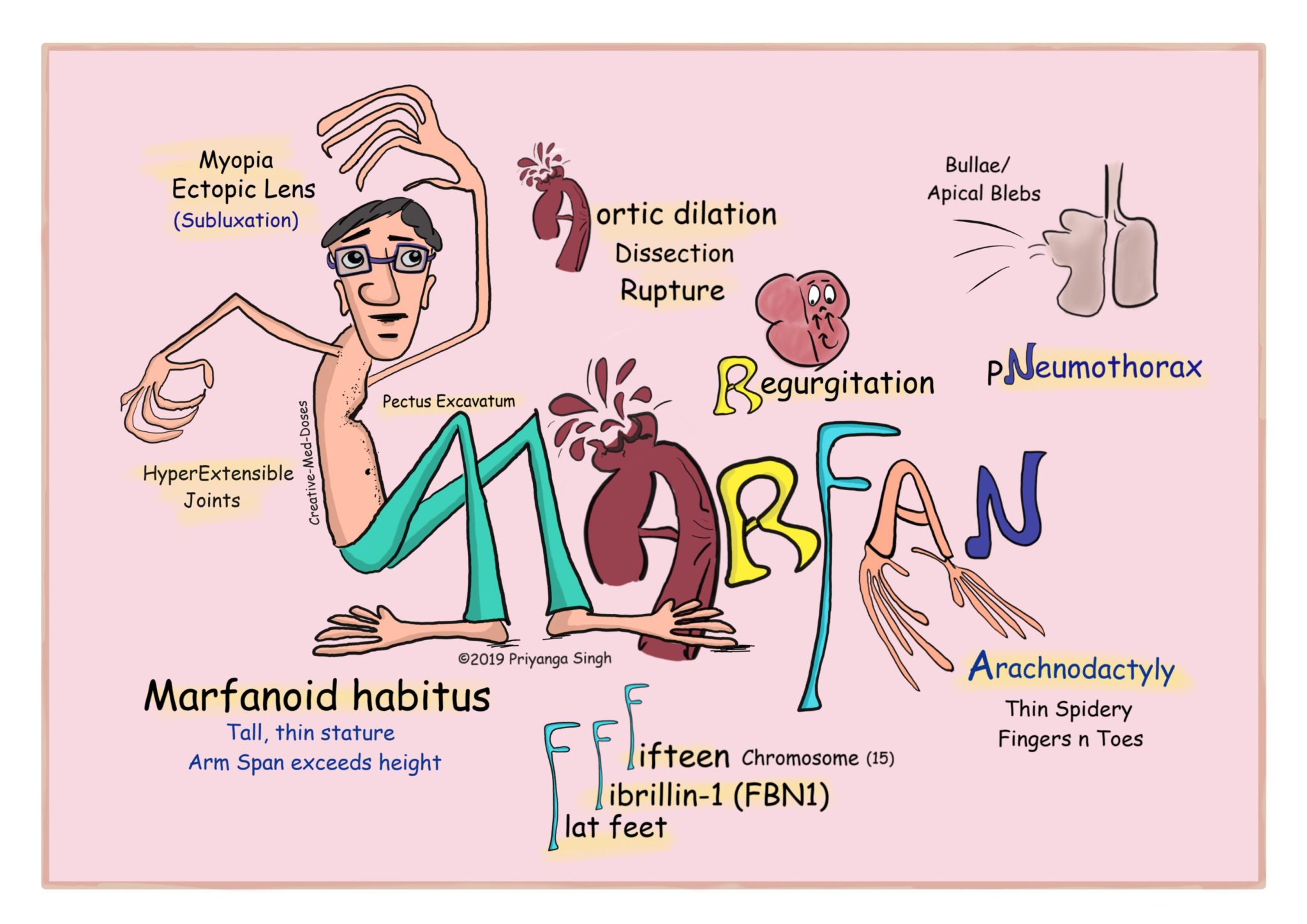 Marfan Syndrome quick review - Creative Med Doses