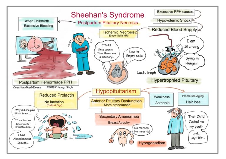 Sheehan's syndrome (Postpartum hypopituitarism) - Creative Med Doses