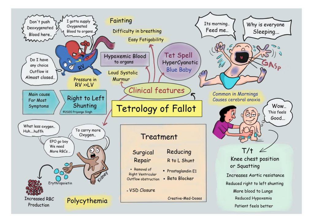 Tetralogy of Fallot: Clinical features and treatment 