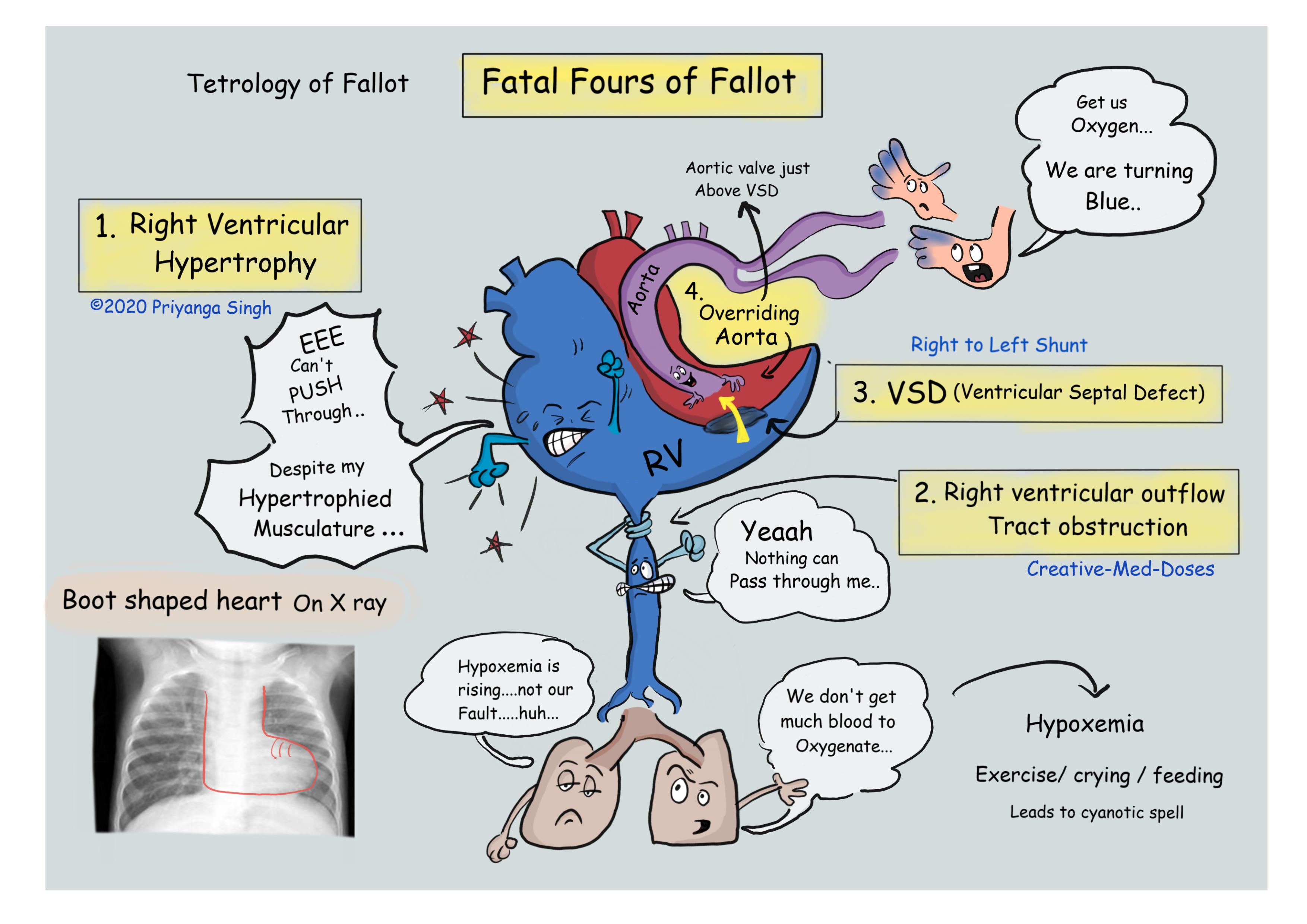 Tetralogy of Fallot: Fatal Four - Creative Med Doses