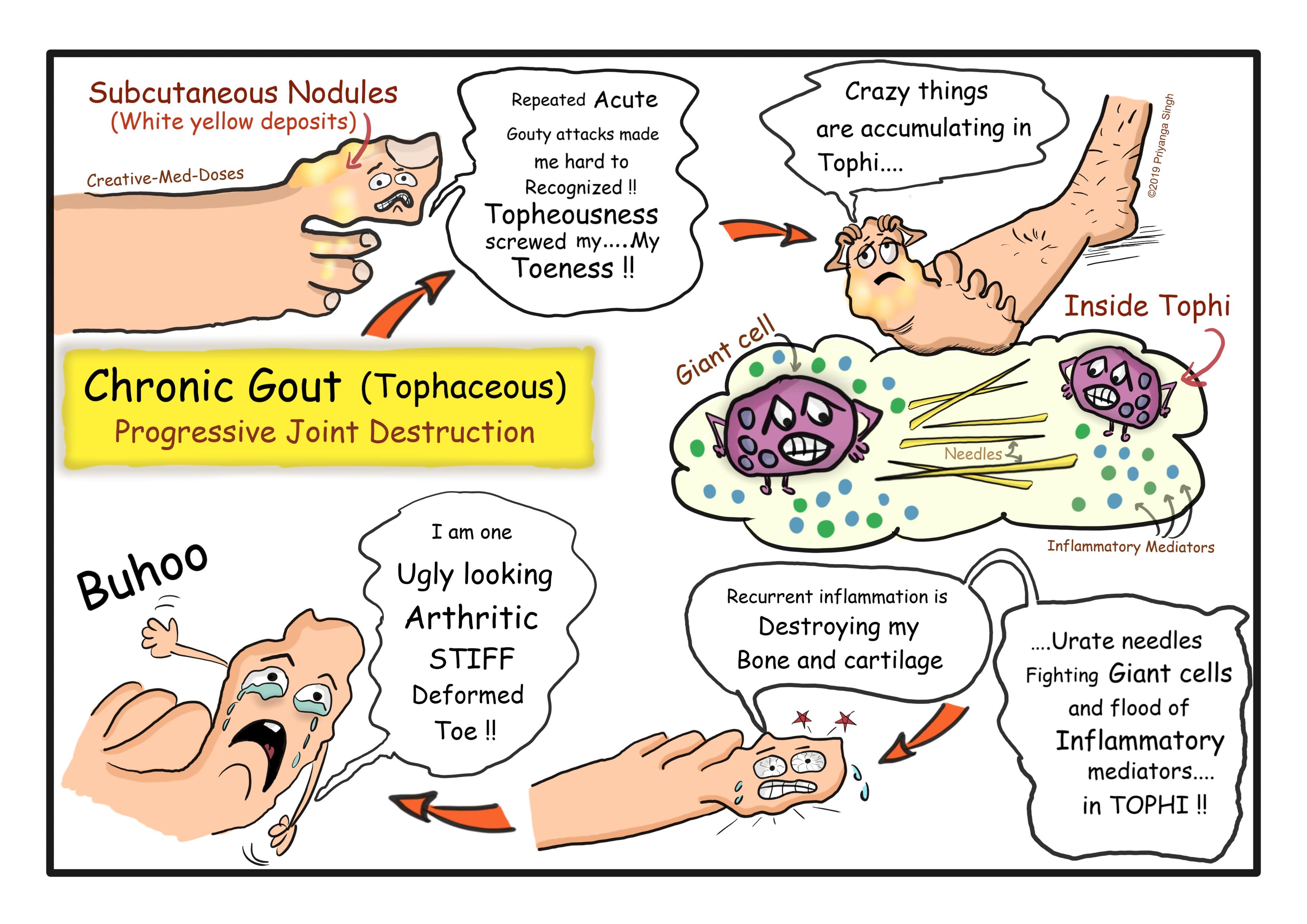 Gout: Chronic progressive joint destruction illustration 