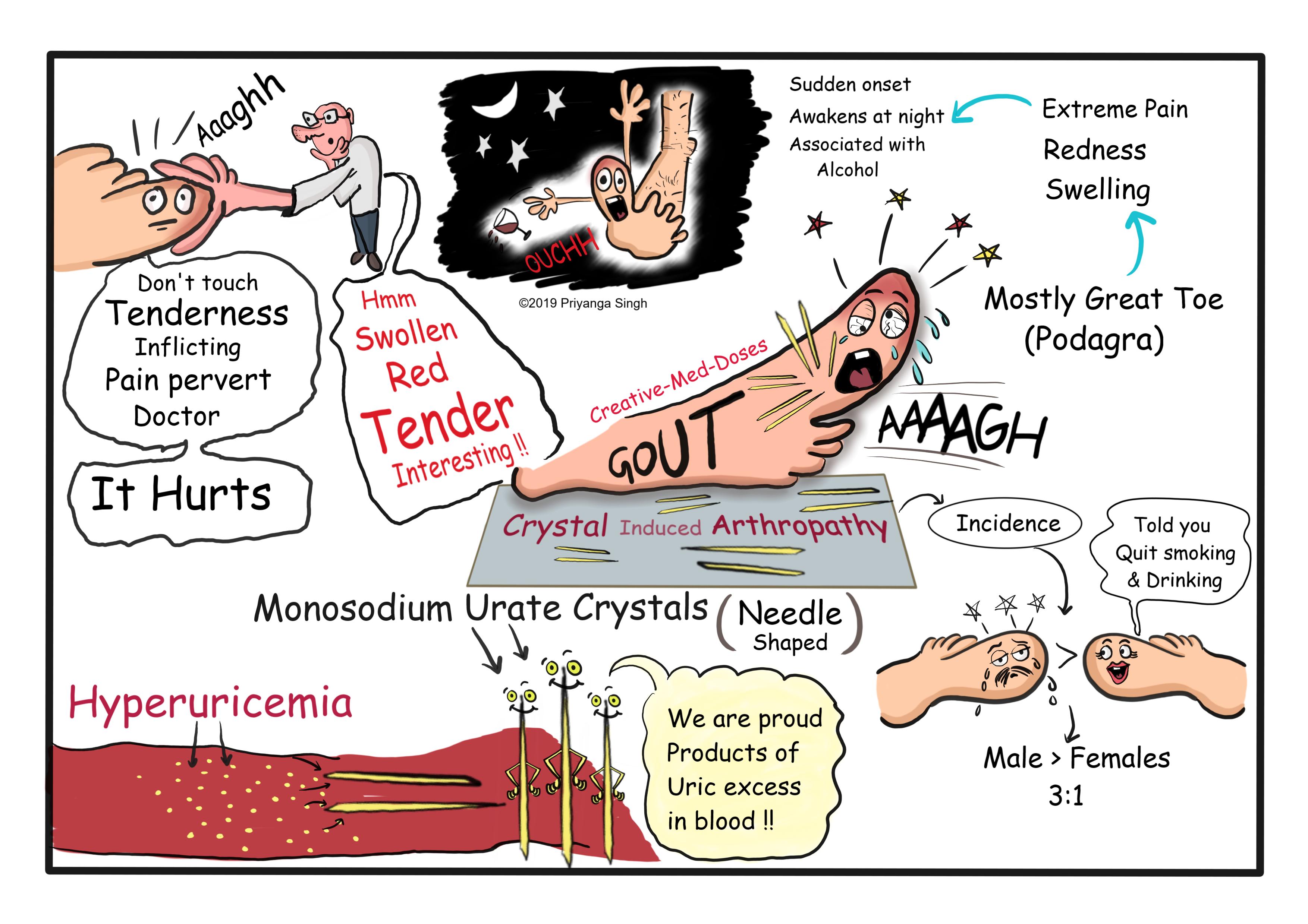 Gout: Acute attack illustration