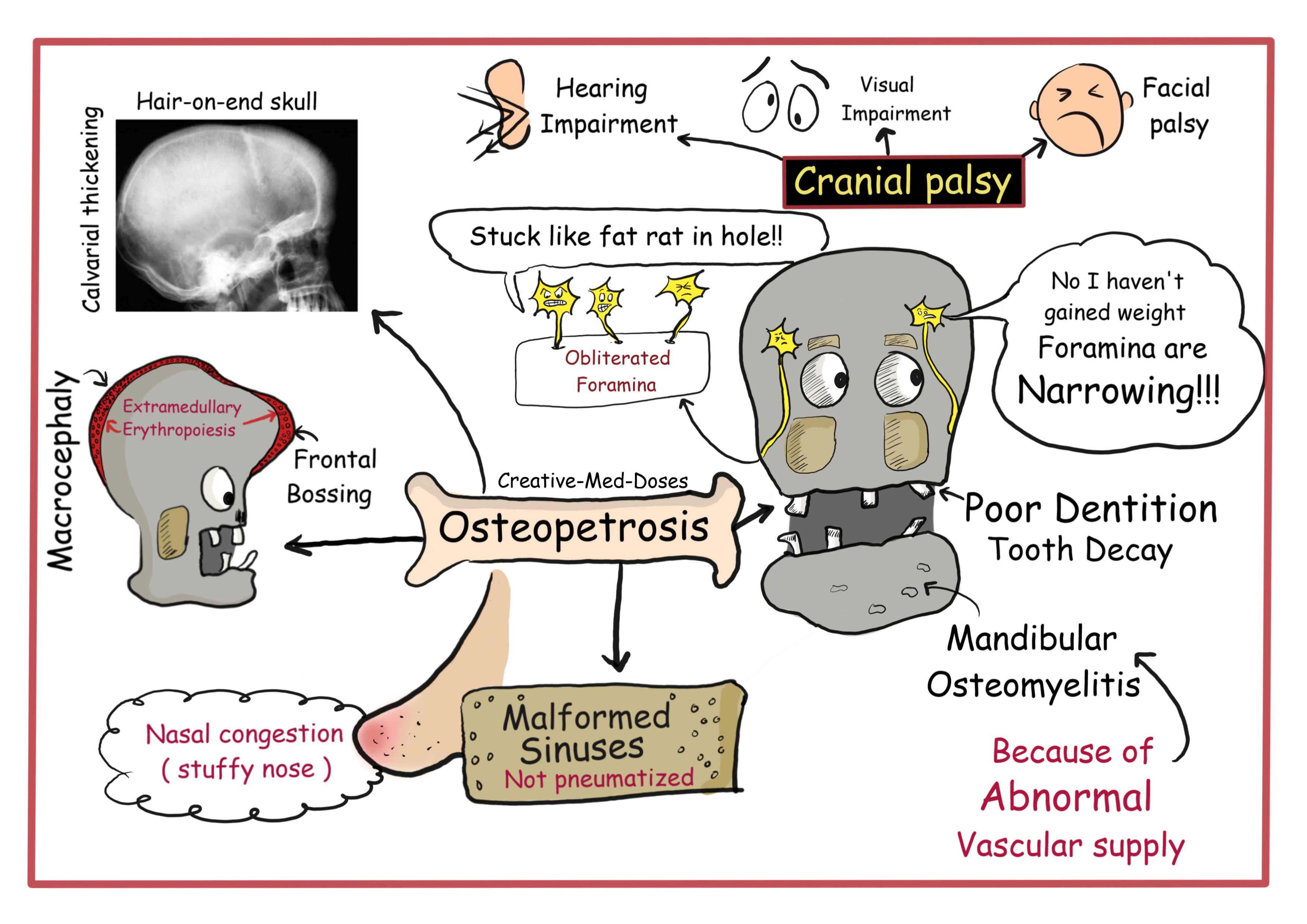 Osteopetrosis cartoons and illustrations 2