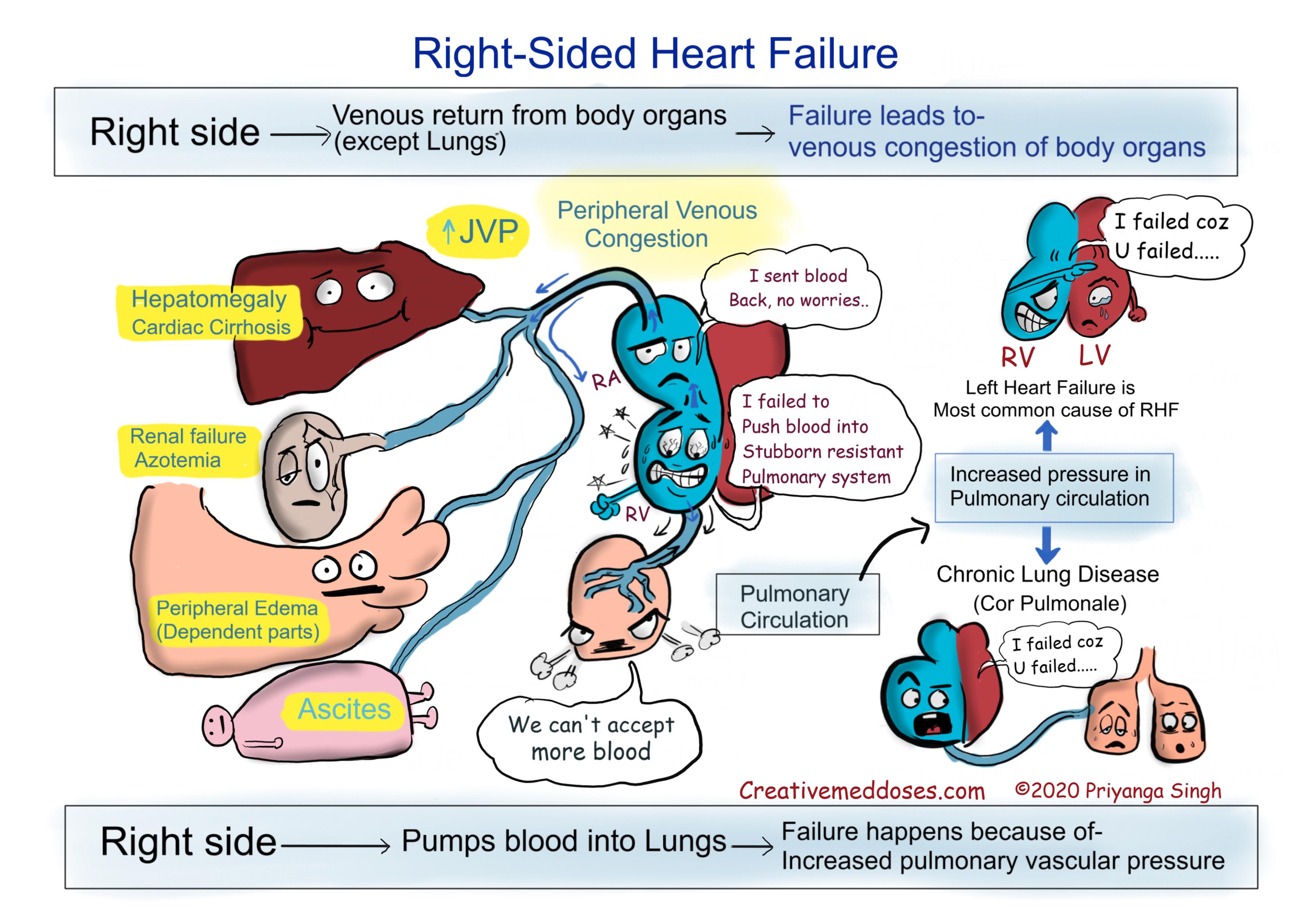right sided heart failure infographics