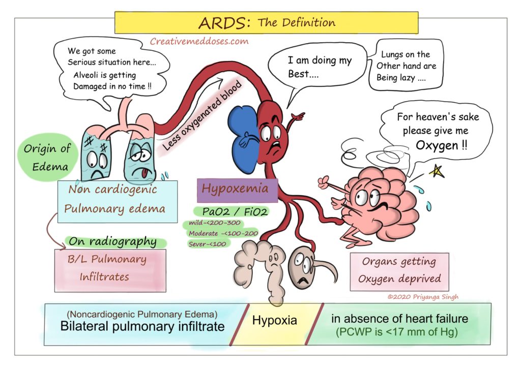 Acute Respiratory Distress Syndrome ARDS Creative Med Doses