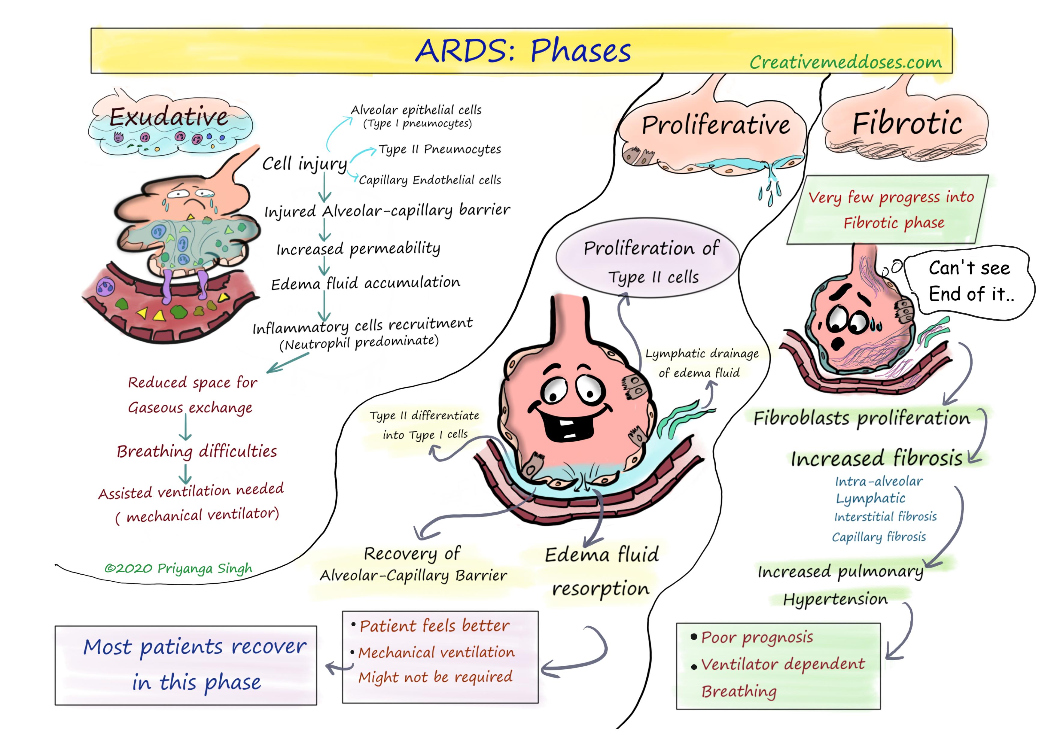 Acute Respiratory Distress Syndrome: Phases image 
