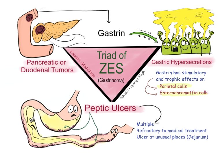 ZOLLINGER–ELLISON SYNDROME: ZES - Creative Med Doses