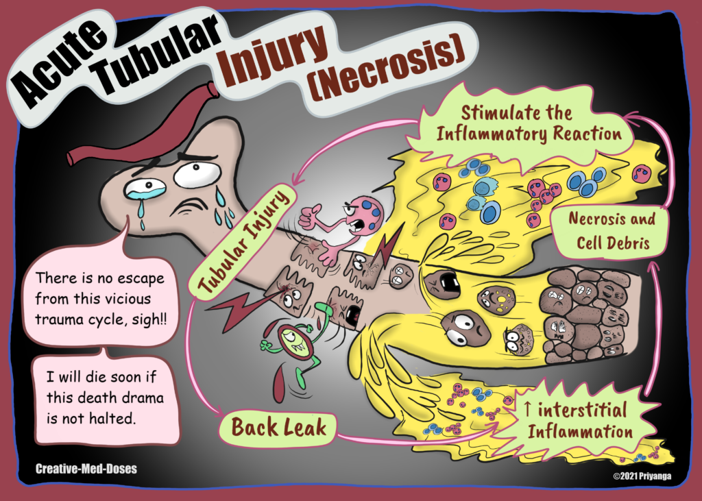 Acute Tubular Necrosis Cartoon