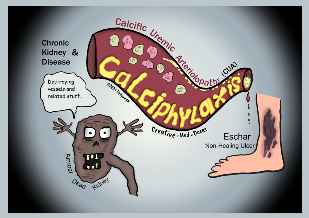 Calciphylaxis or calcific uremic arteriolopathy in CKD - Creative Med Doses