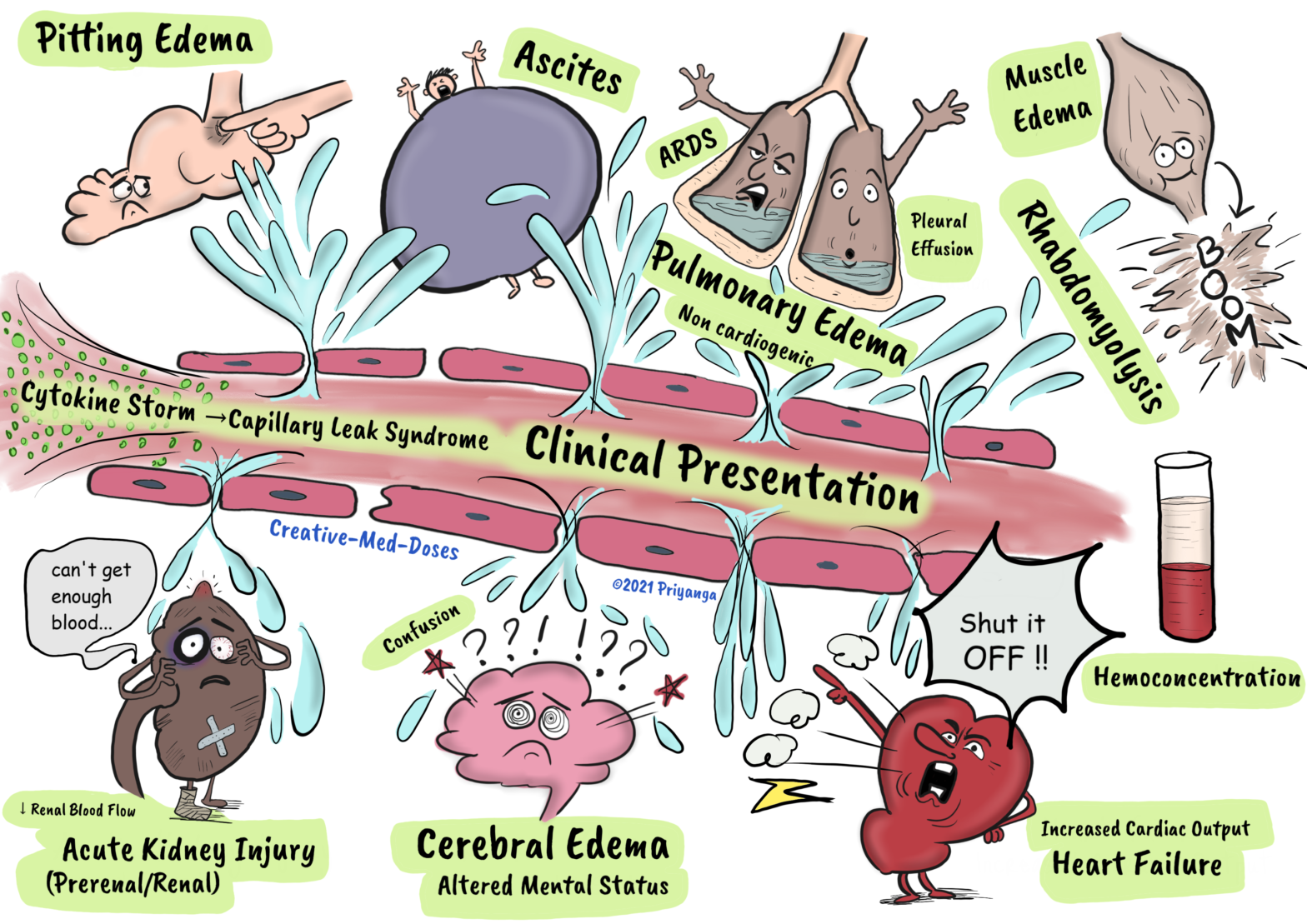 Capillary leak syndrome (cls): quick review - creative med doses