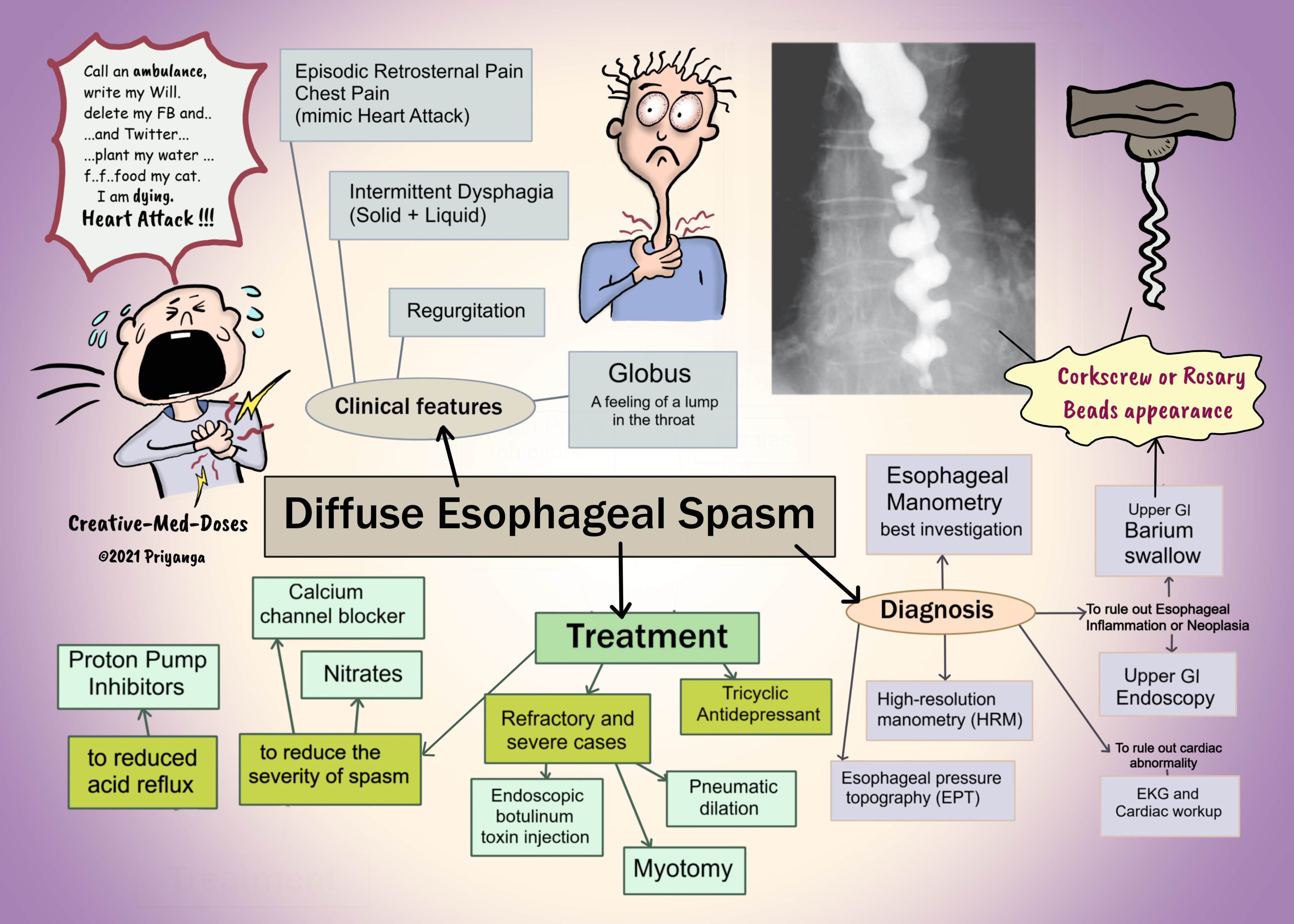 Diffuse esophageal spasm,Corkscrew or rosary beads appearance on barium study 