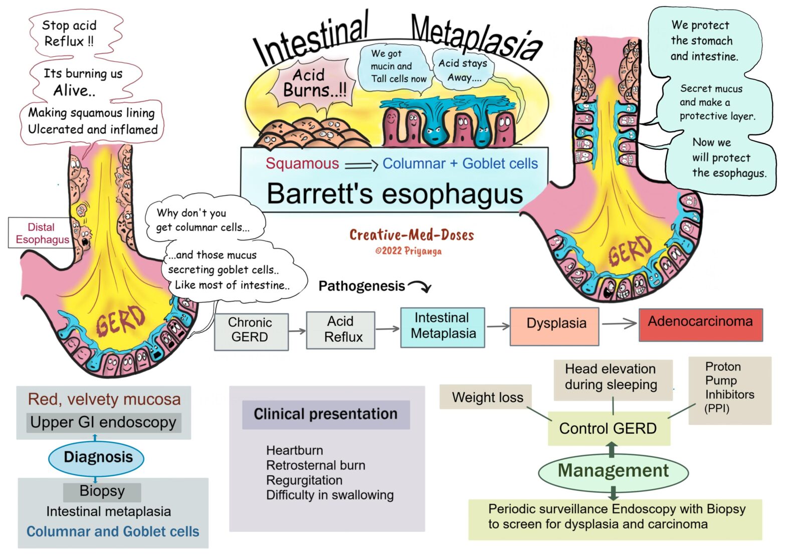 Barrett’s esophagus