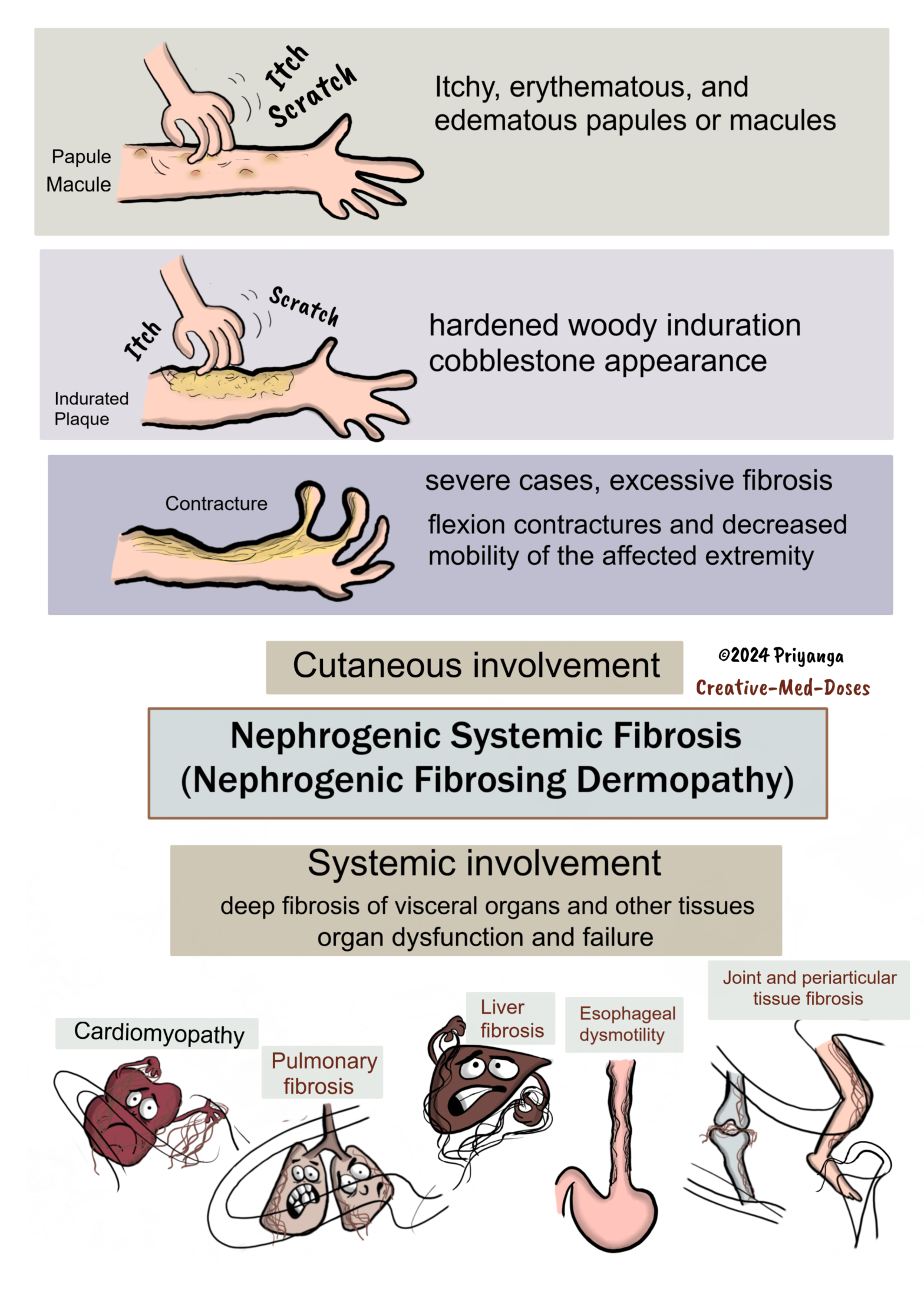 Nephrogenic Systemic Fibrosis Nephrogenic Fibrosing Dermopathy   Nephrogenic Systemic Fibrosis Clinical Features P2 PNG 1568x2195 