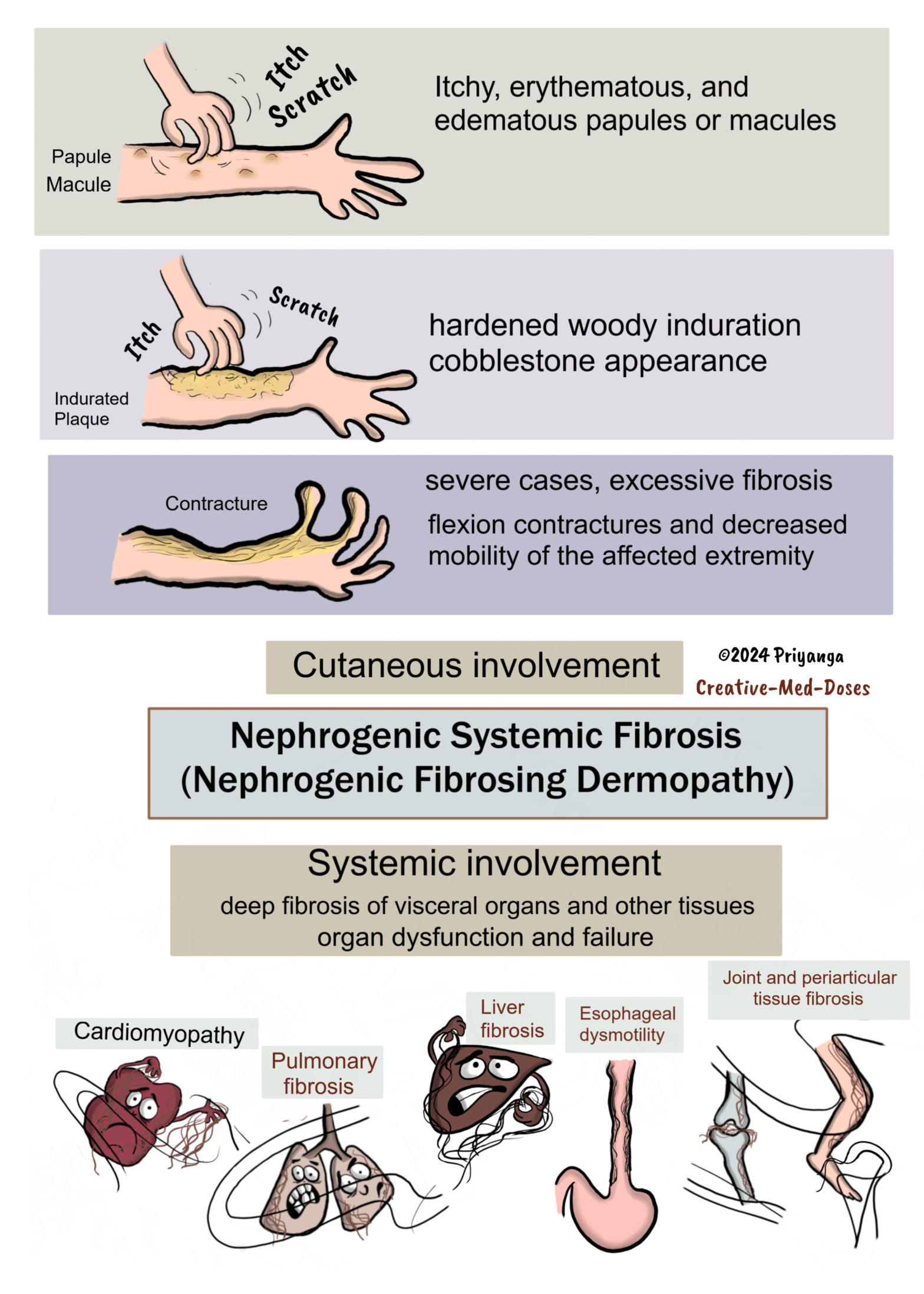 Nephrogenic Systemic Fibrosis nephrogenic Fibrosing Dermopathy 