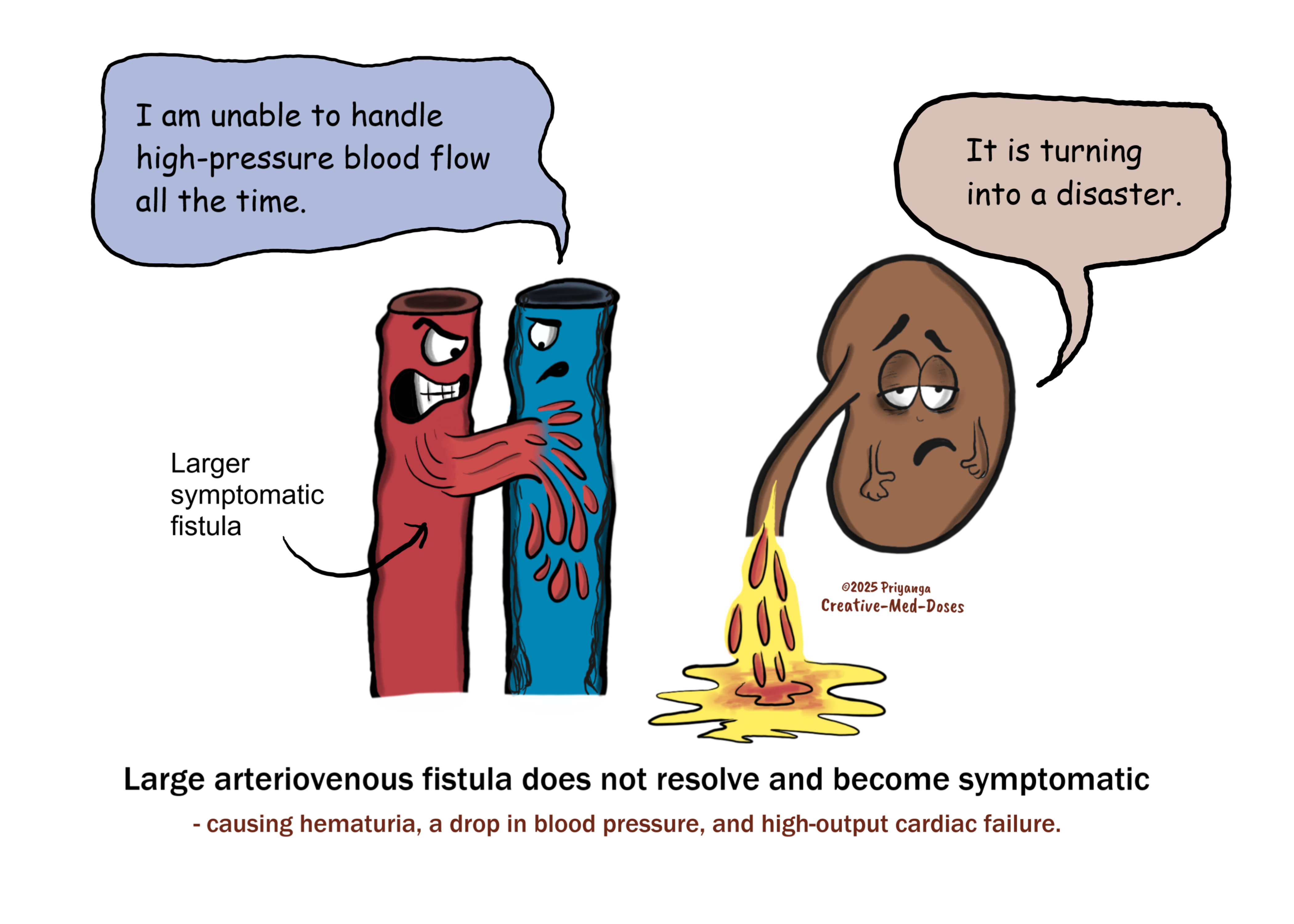 Large arteriovenous fistula