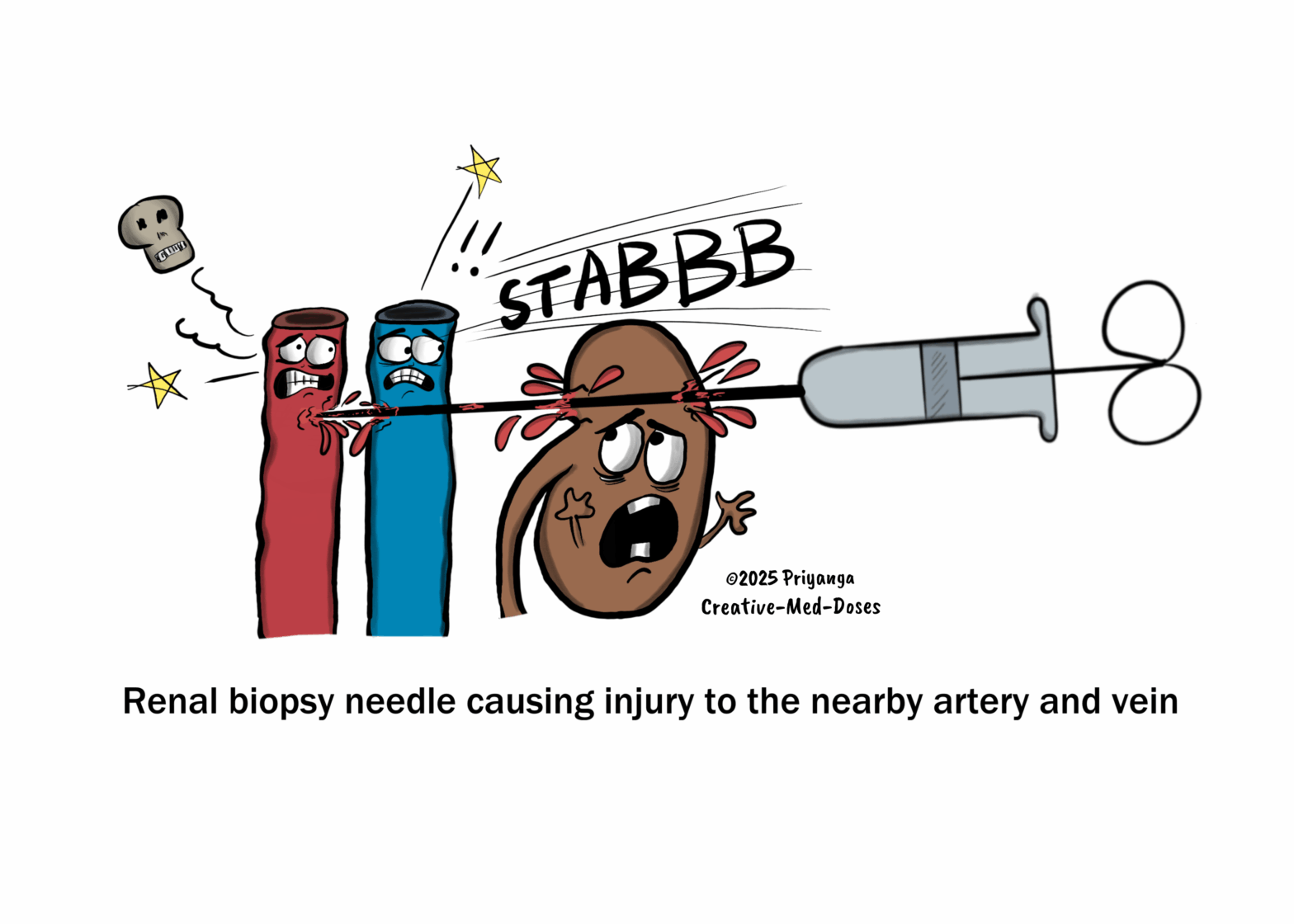 Arteriovenous fistula in renal biopsy: the injury